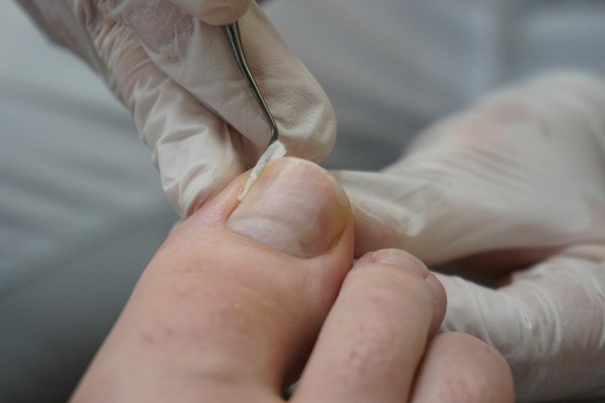 Ingrown Toenail