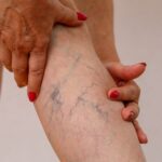 Serious signs of vein problems in the elderly