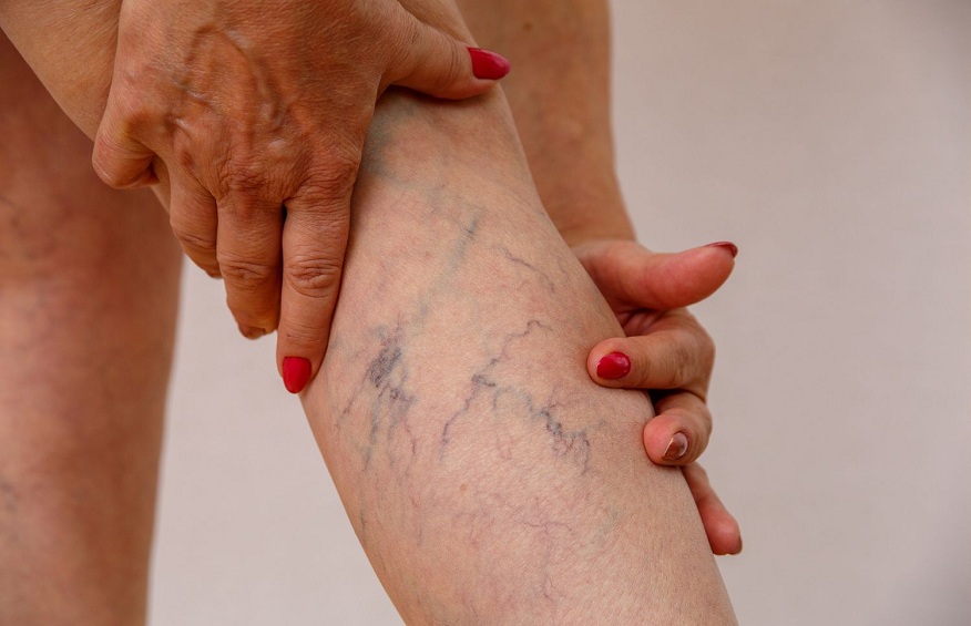 signs of vein problems i